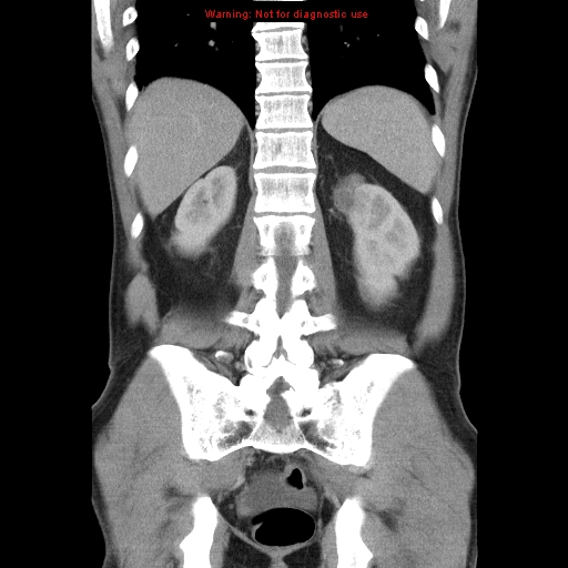File:Appendicitis and renal cell carcinoma (Radiopaedia 17063-16760 B 23).jpg