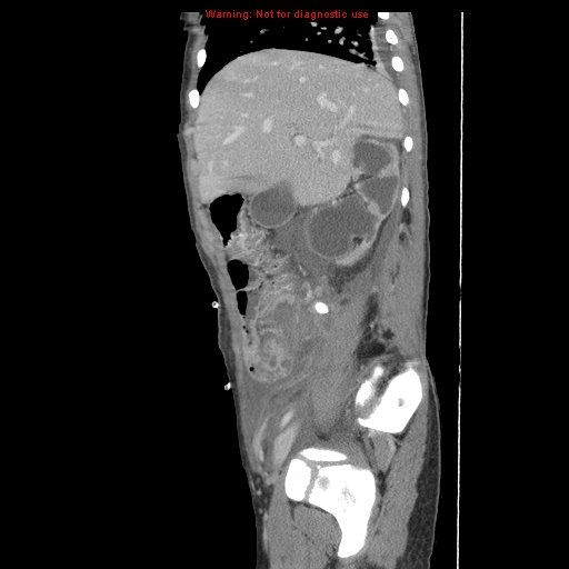 File:Appendicitis with phlegmon (Radiopaedia 9358-10046 F 15).jpg