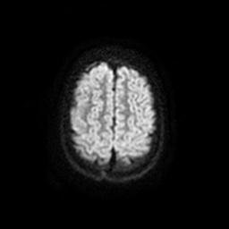 Arachnoid cyst - middle cranial fossa (Radiopaedia 67671-77088 Axial DWI 24).jpg