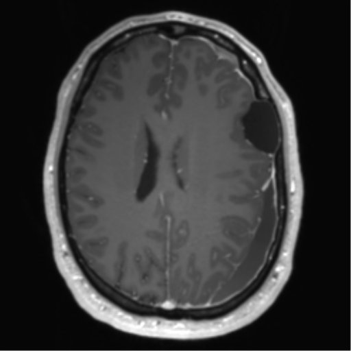 Arachnoid cyst with subdural hematoma (Radiopaedia 85892-101743 Axial T1 C+ 55).png
