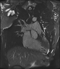 Arrhythmogenic right ventricular cardiomyopathy (Radiopaedia 57972-64966 CINE R2 SSFP 6).jpg