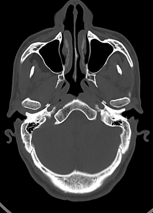 Arrow injury to the head (Radiopaedia 75266-86388 Axial bone window 48).jpg