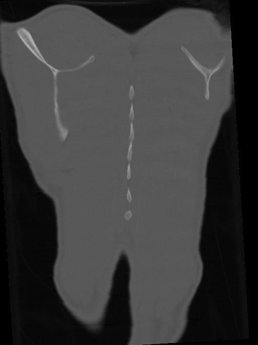 Arrow injury to the neck (Radiopaedia 75225-86323 Coronal bone window 109).jpg
