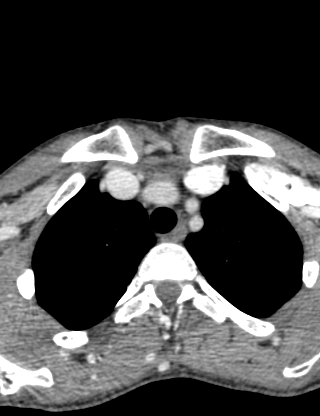 Arteriovenous malformation of the neck (Radiopaedia 53935-60062 B 52).jpg