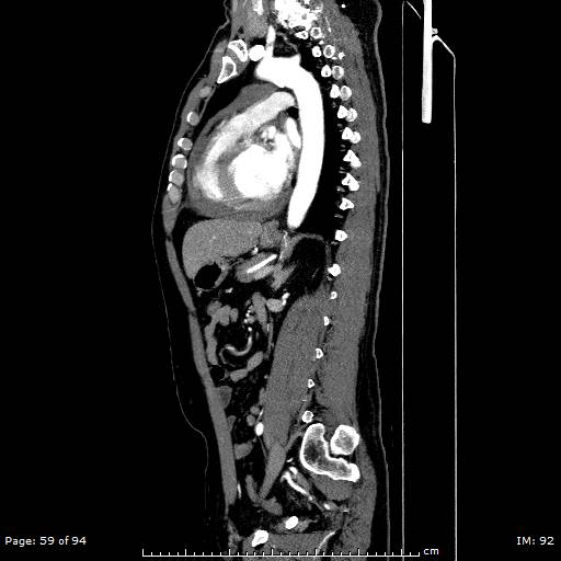 Ascending aortic aneurysm (Radiopaedia 50086-55404 C 42).jpg
