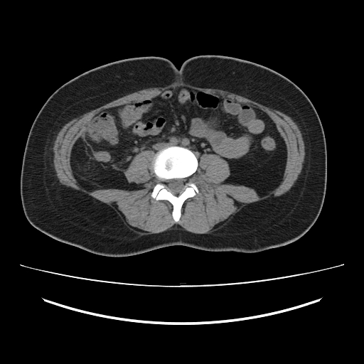 Ascending retrocecal appendicitis with liver abscesses (Radiopaedia 60066-67615 Axial non-contrast 51).jpg