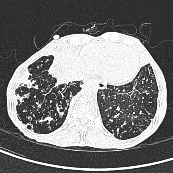 Aspergilloma- with Monod sign (Radiopaedia 44737-48532 Axial lung window 238).jpg