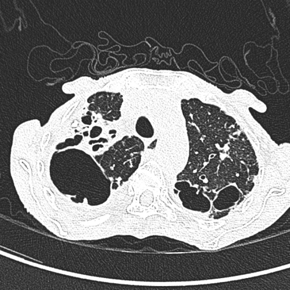 Aspergilloma- with Monod sign (Radiopaedia 44737-48532 Axial lung window 72).jpg