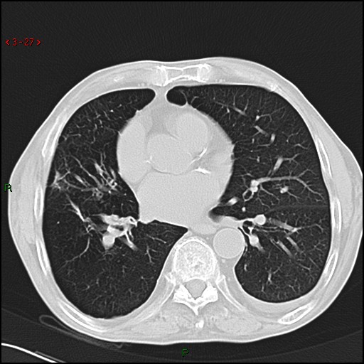 File:Aspergilloma (Radiopaedia 14842-14787 Axial lung window 27).jpg