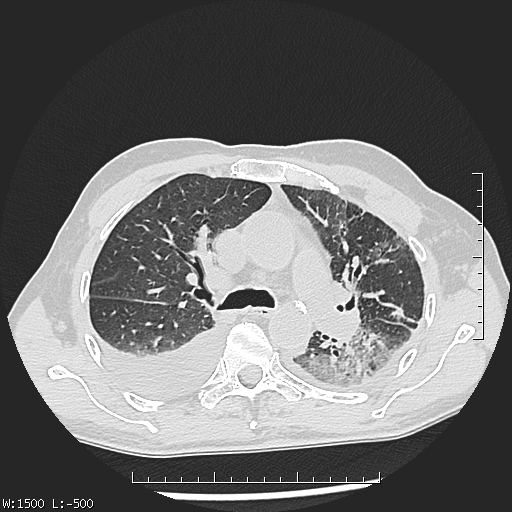 File:Aspergilloma (Radiopaedia 75184-86270 Axial lung window 19).jpg