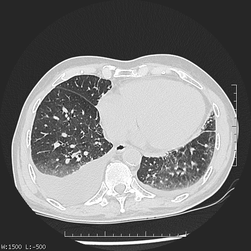 Aspergilloma (Radiopaedia 75184-86270 Axial lung window 39).jpg