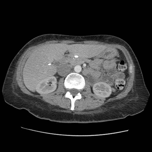 File:Aspiration pneumonia secondary to laparoscopic banding (Radiopaedia 18345-18183 A 64).jpg