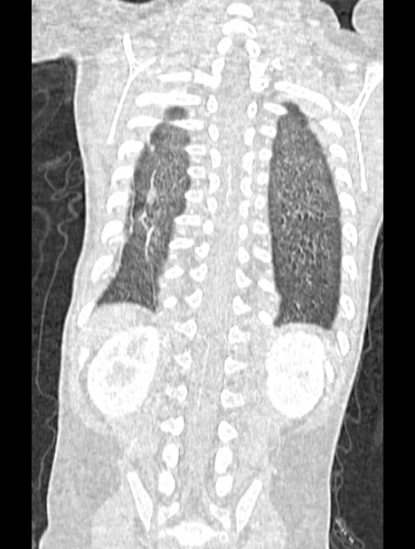 Asplenia syndrome (Radiopaedia 73083-83792 Coronal lung window 117).jpg