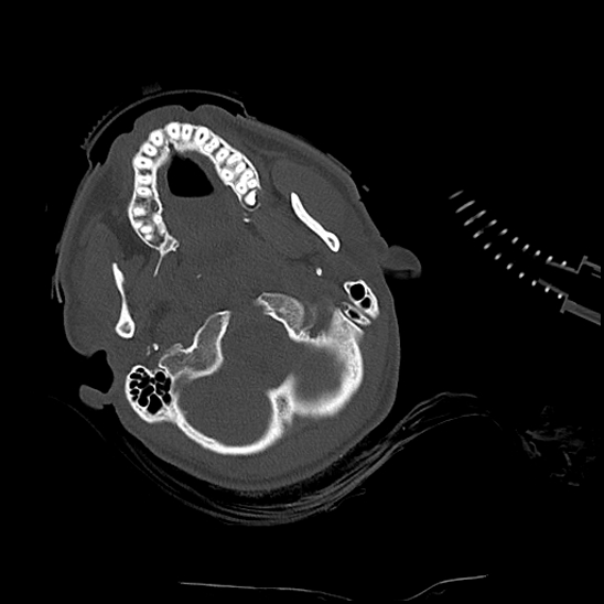 Atlanto-occipital dissociation (Traynelis type 1), C2 teardrop fracture, C6-7 facet joint dislocation (Radiopaedia 87655-104061 Axial bone window 13).jpg