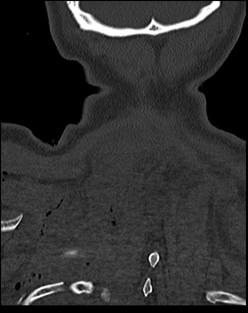 Atlanto-occipital dissociation - Traynelis type 1 (Radiopaedia 87570-103948 Coronal bone window 56).jpg