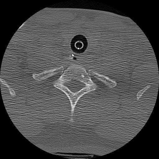 Atlanto-occipital dissociation injury (Radiopaedia 29274-29698 Axial bone window 71).png