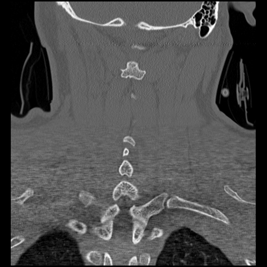 Atlanto-occipital dissociation injury (Radiopaedia 29274-29698 Coronal bone window 11).png