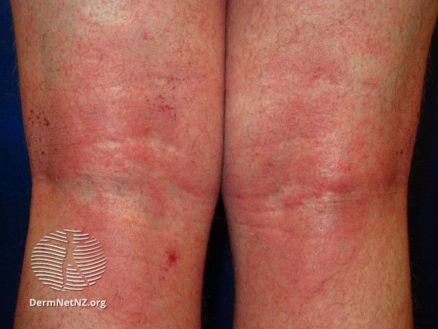 File:Atopic dermatitis (DermNet NZ SCORAD-atopic-swollen-2).jpg