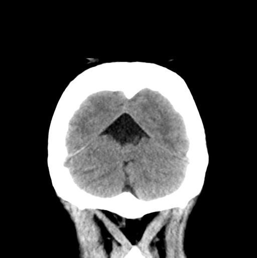 File:Atretic encephalocoele with inferior vermis hypoplasia (Radiopaedia 30443-31107 Coronal non-contrast 33).jpg