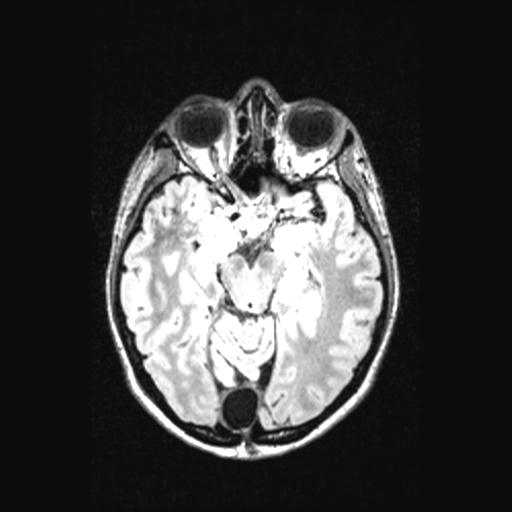 File:Atretic encephalocoele with inferior vermis hypoplasia (Radiopaedia 30443-31108 Axial 65).jpg