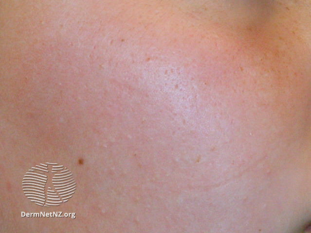 File:Atrophoderma vermiculata (DermNet NZ acne-keratosis-pilaris-3).jpg
