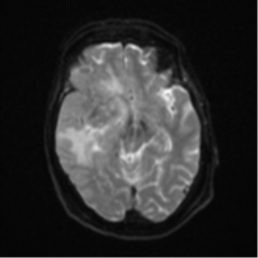Atypical meningioma (WHO Grade II) (Radiopaedia 54742-60979 Axial DWI 12).png