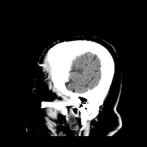 Atypical meningioma (WHO grade II) with brain invasion (Radiopaedia 57767-64728 Sagittal C+ 4).png