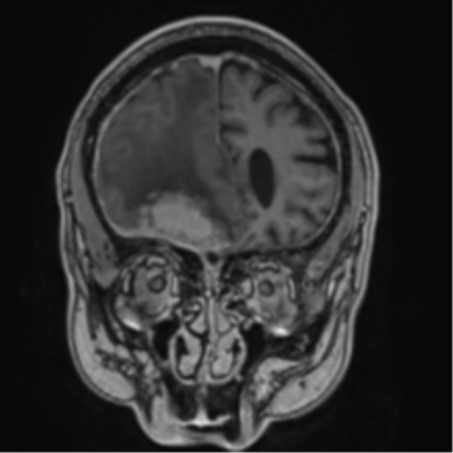Atypical meningioma (WHO grade II) with brain invasion (Radiopaedia 57767-64729 Coronal T1 C+ 19).png