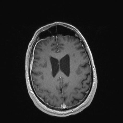 Atypical meningioma (grade II) - en plaque (Radiopaedia 29633-30147 Axial T1 C+ 129).jpg