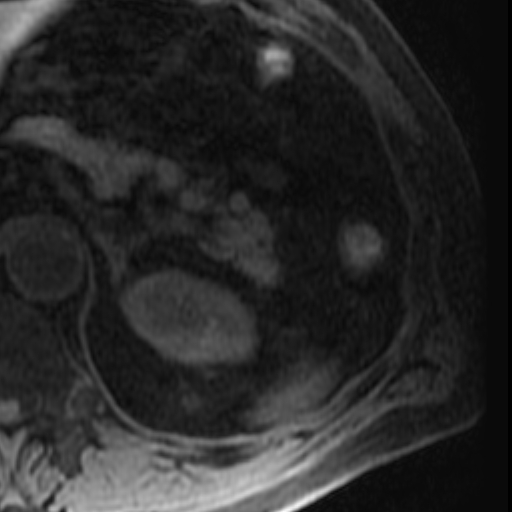 File:Atypical renal cyst on MRI (Radiopaedia 17349-17046 Axial T1 fat sat 6).jpg