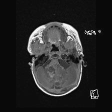Atypical teratoid rhabdoid tumor (prenatal US and neonatal MRI) (Radiopaedia 59091-66388 Axial T1 14).jpg