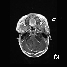 Atypical teratoid rhabdoid tumor (prenatal US and neonatal MRI) (Radiopaedia 59091-66388 Axial T1 C+ 14).jpg