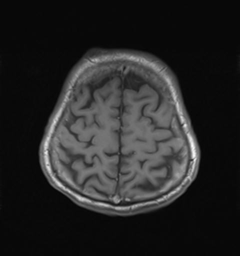 File:Autoimmune limbic encephalitis (Radiopaedia 30363-31005 Axial T1 27).jpg