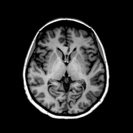 File:Autoimmune limbic encephalitis (Radiopaedia 30363-31005 T1 Axial 1mm 78).jpg