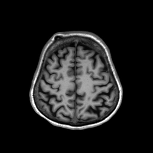 Autoimmune limbic encephalitis (Radiopaedia 30363-31005 T1 Axial 3mm 40).jpg