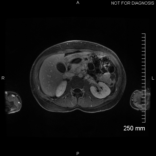 File:Autoimmune pancreatitis (Radiopaedia 88443-105101 A 69).jpg
