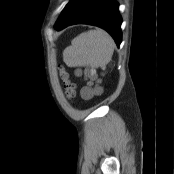 File:Autosomal dominant polycystic kidney disease (Radiopaedia 36539-38101 D 74).jpg
