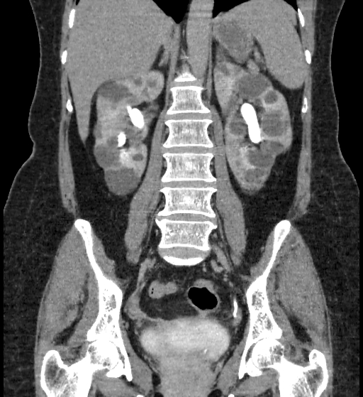 Autosomal dominant polycystic kidney disease (Radiopaedia 38189-40194 Coronal C+ delayed 59).jpg
