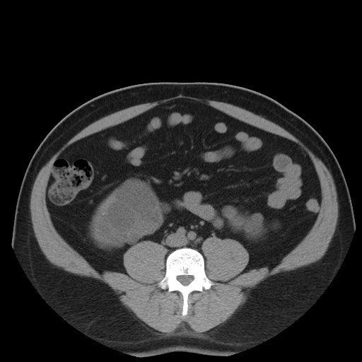 Autosomal dominant polycystic kidney disease (Radiopaedia 50259-55612 Axial non-contrast 52).jpg
