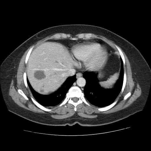 File:Autosomal dominant polycystic kidney disease with hepatic involvement (Radiopaedia 32693-33662 B 8).jpg