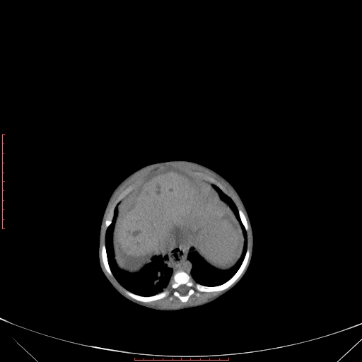 Autosomal recessive polycystic kidney disease associated with Caroli disease (Radiopaedia 61932-69984 Axial non-contrast 102).jpg
