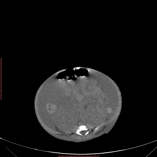 Autosomal recessive polycystic kidney disease associated with Caroli disease (Radiopaedia 61932-69984 Axial non-contrast 257).jpg