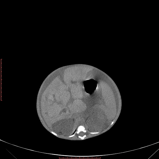 File:Autosomal recessive polycystic kidney disease associated with Caroli disease (Radiopaedia 61932-69984 B 160).jpg
