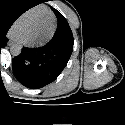 File:Avascular necrosis after fracture dislocations of the proximal humerus (Radiopaedia 88078-104653 D 96).jpg
