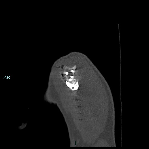 Avascular necrosis after fracture dislocations of the proximal humerus (Radiopaedia 88078-104655 Sagittal bone window 9).jpg