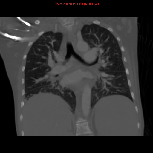 File:Avascular necrosis in sickle cell disease (Radiopaedia 17448-17152 Coronal bone window 73).jpg