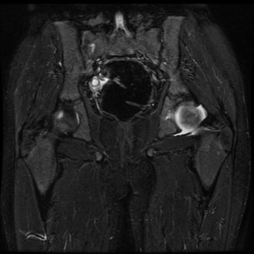 File:Avascular necrosis of the hip (Radiopaedia 29563-30067 Coronal T2 fat sat 11).jpg