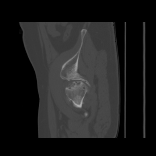 File:Avascular necrosis of the hip (Radiopaedia 61503-69467 B 50).jpg