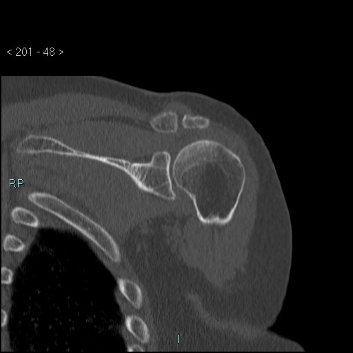 Avascular necrosis of the shoulder - Cruess stage I (Radiopaedia 77674-89887 Coronal bone window 47).jpg