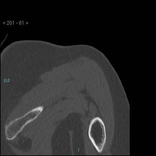 Avascular necrosis of the shoulder - Cruess stage I (Radiopaedia 77674-89887 Coronal bone window 80).jpg